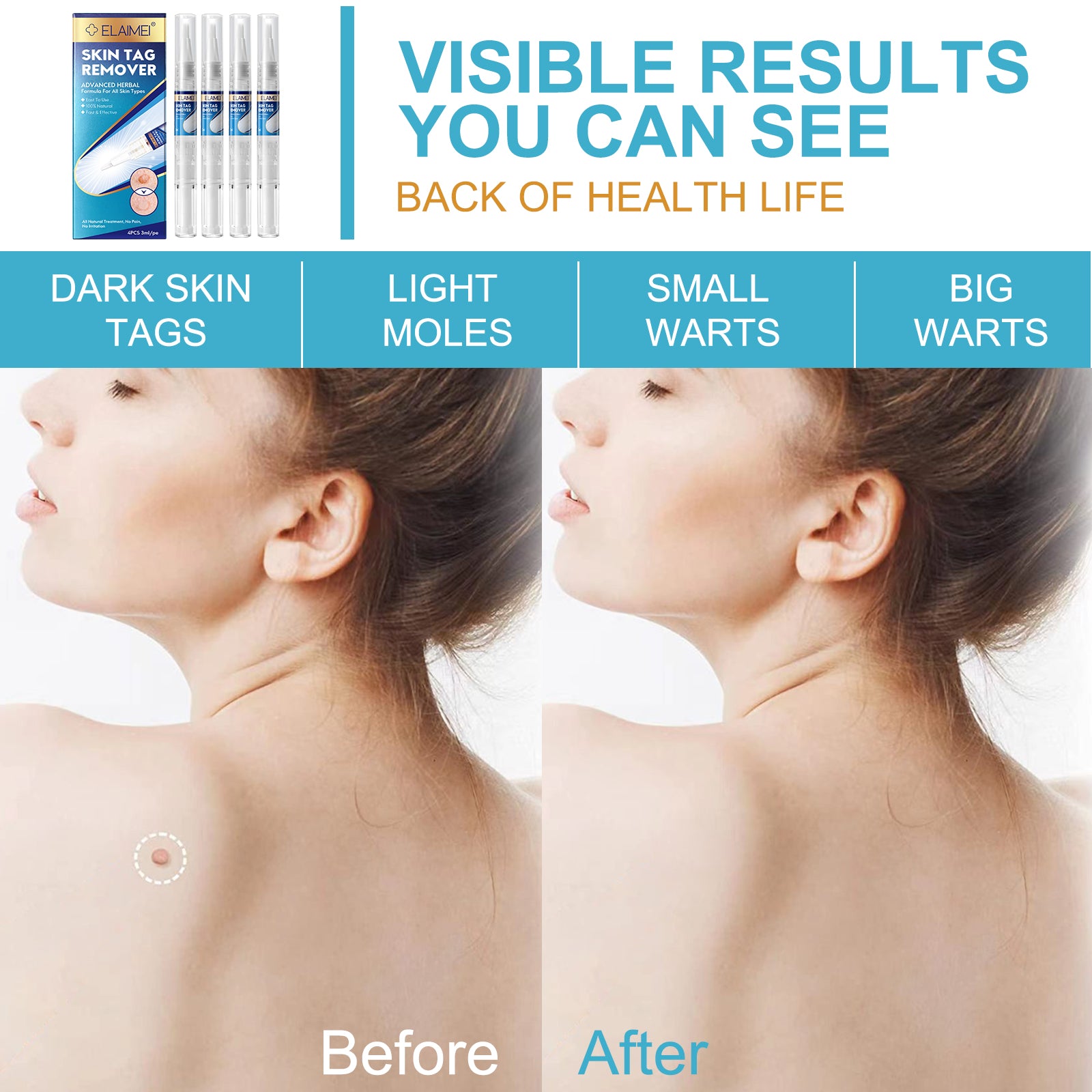 ELAIMEI Skin Tag Remover Kit, Anti Mole & Wart Body Pens, 4pcs