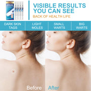 ELAIMEI Skin Tag Remover Kit, Anti Mole & Wart Body Pens, 4pcs
