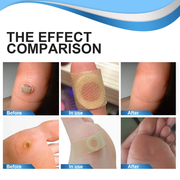 Aliver Foot Corn Wart Remover Pads 24pcs Plasters