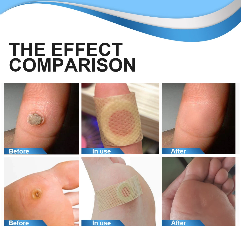 Aliver Foot Corn Wart Remover Pads 24pcs Plasters