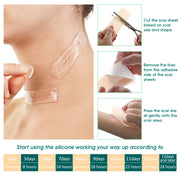 Elaimei Silicone Sheets for Scar Removal