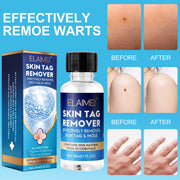 ELAIMEI Skin Tag Remover, Wart & Mole Body Liquid, 30ml