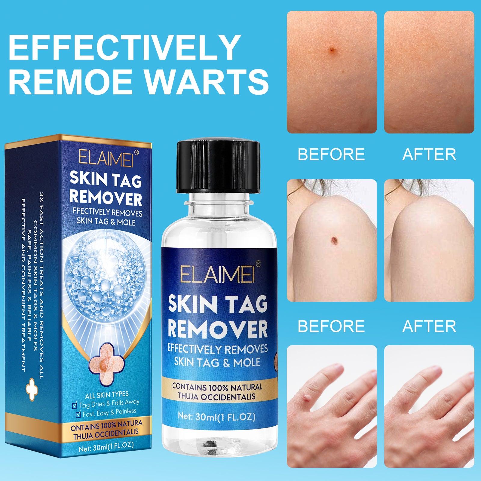 ELAIMEI Skin Tag Remover, Wart & Mole Body Liquid, 30ml