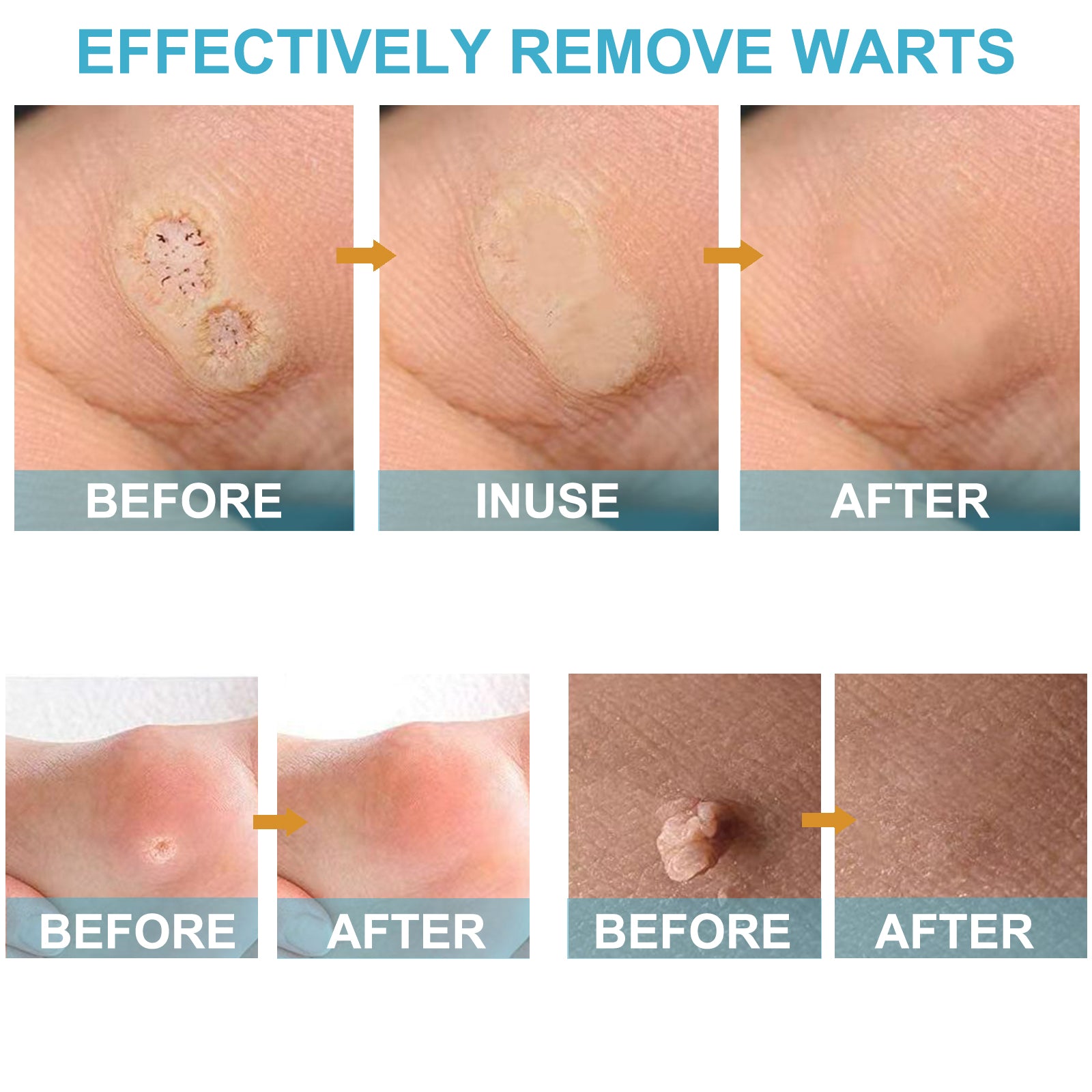 ELAIMEI Skin Tag Remover Kit, Anti Mole & Wart Body Pens, 4pcs