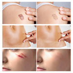 REVIGLAN TCM Scar And Acne Mark Removal Gel Ointment, 30g