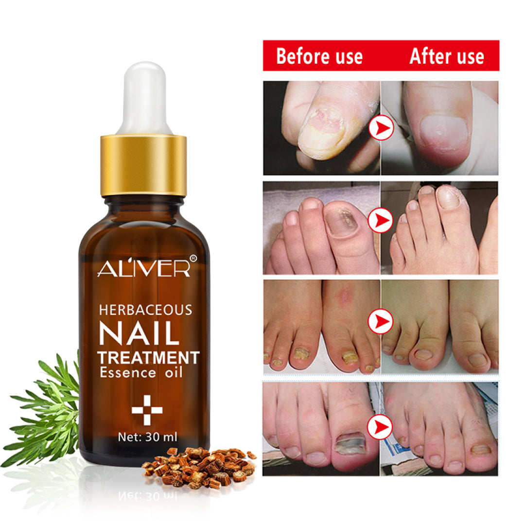 Aliver Fungus Nail Anti Fungal Infection Oil Treatment