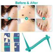 ALIVER 2in1 Skin Tag Remover Kit