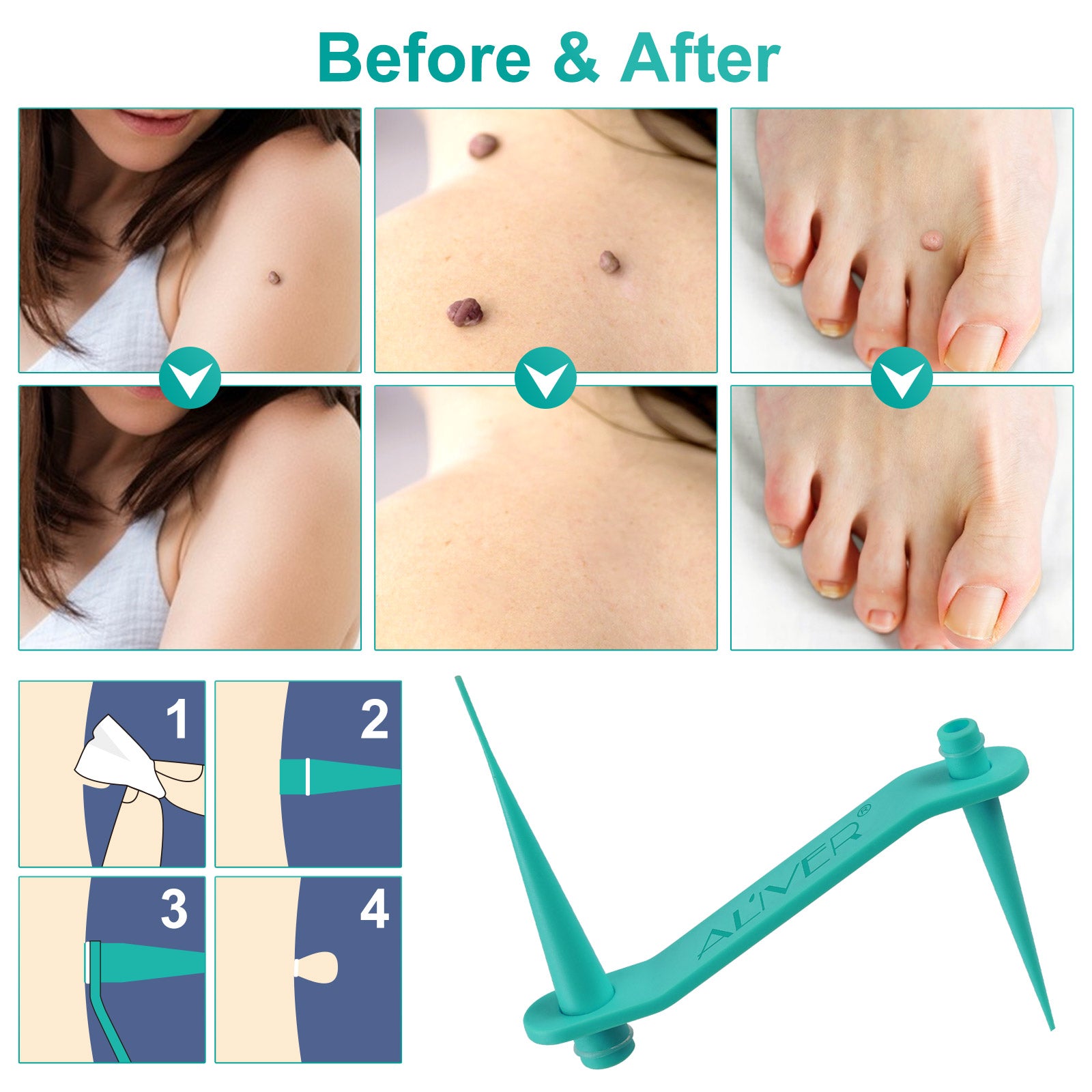 ALIVER 2in1 Skin Tag Remover Kit