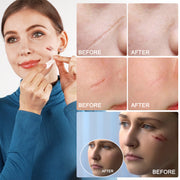 ALIVER Silicone Scar Removal Sheet, 1.5m