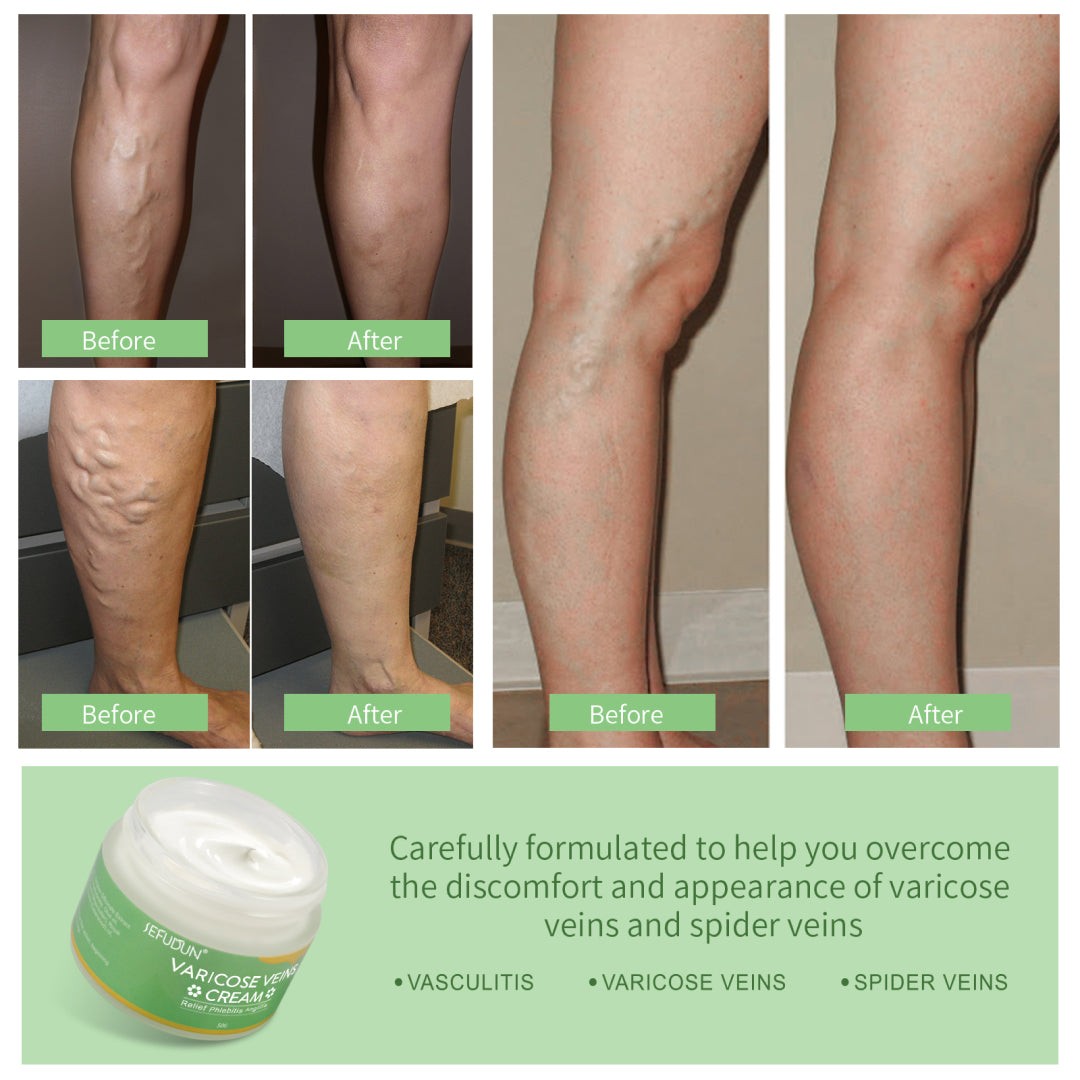 SEFUDUN Varicose Veins Cream, 50g