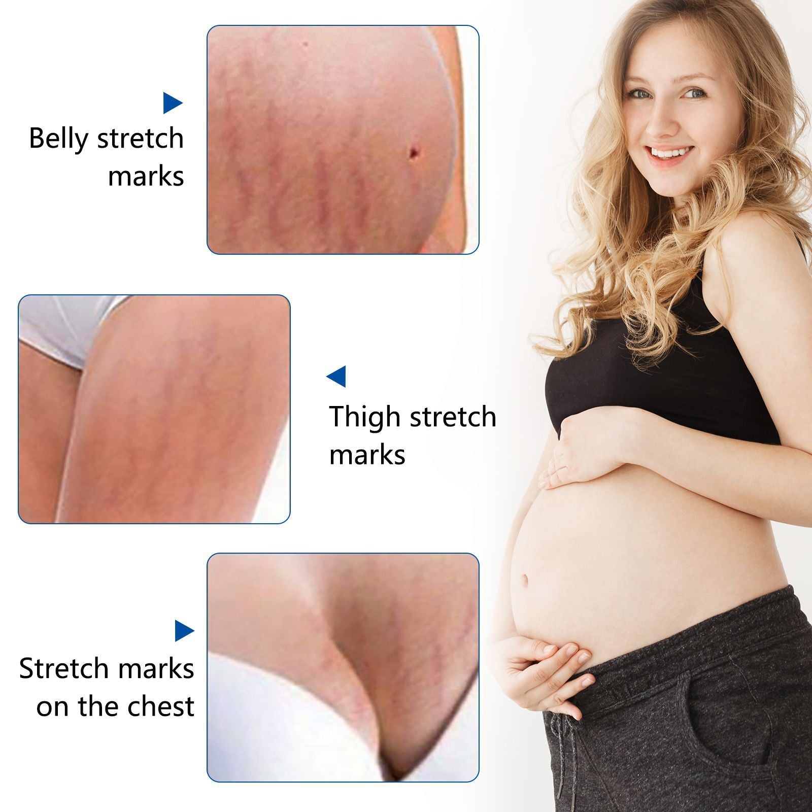SEFUDUN Anti Stretch Mark Essential Oil, 30ml