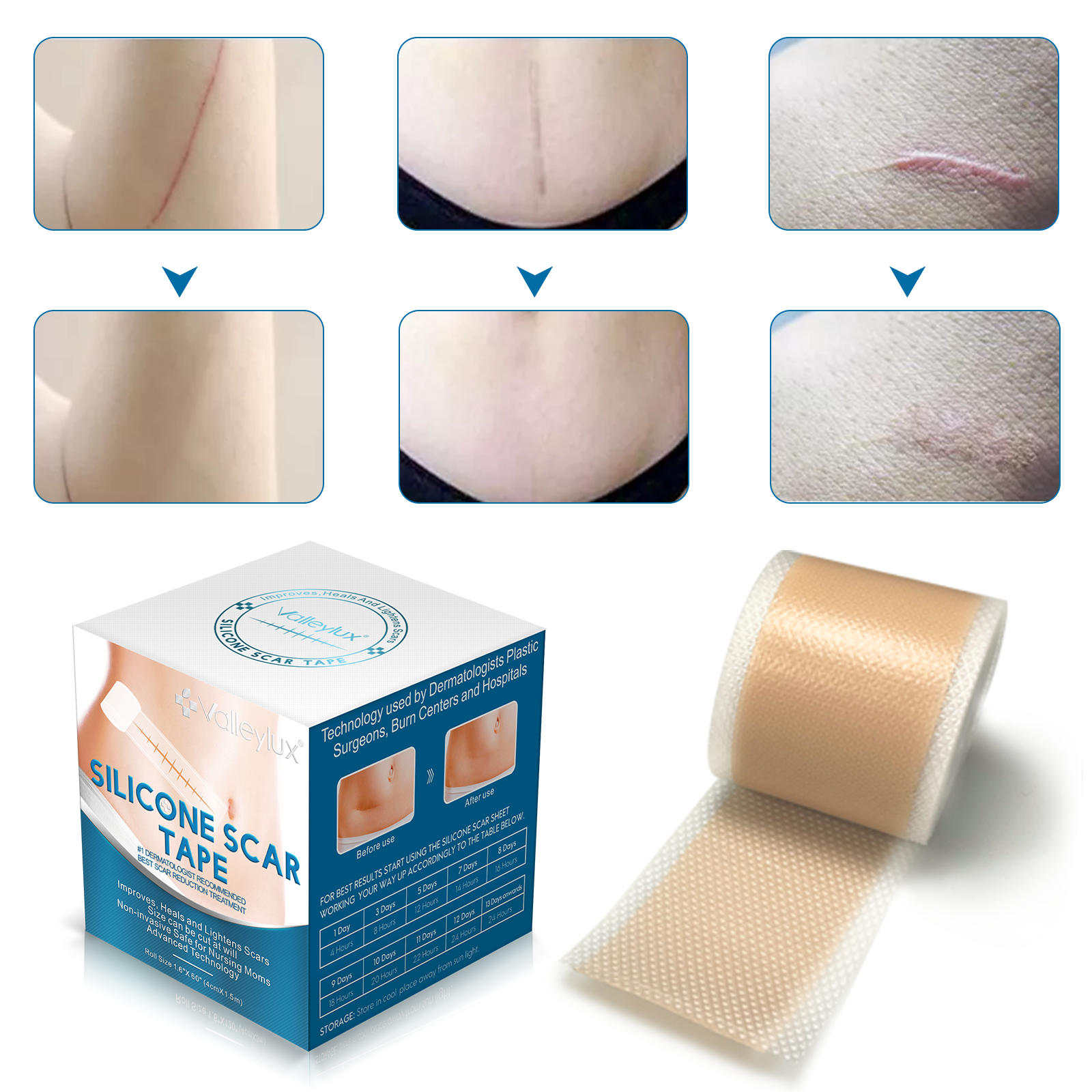 VALLEYLUX Silicone Scar Tape, 1.5m