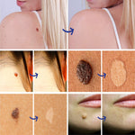 SEFUDUN Skin Tag & Wart Removal Cream, 20g