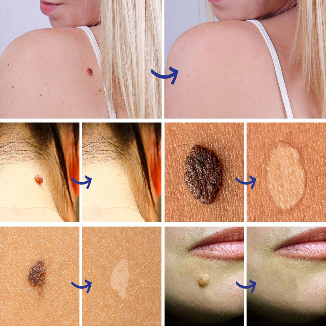 SEFUDUN Skin Tag & Wart Removal Cream, 20g