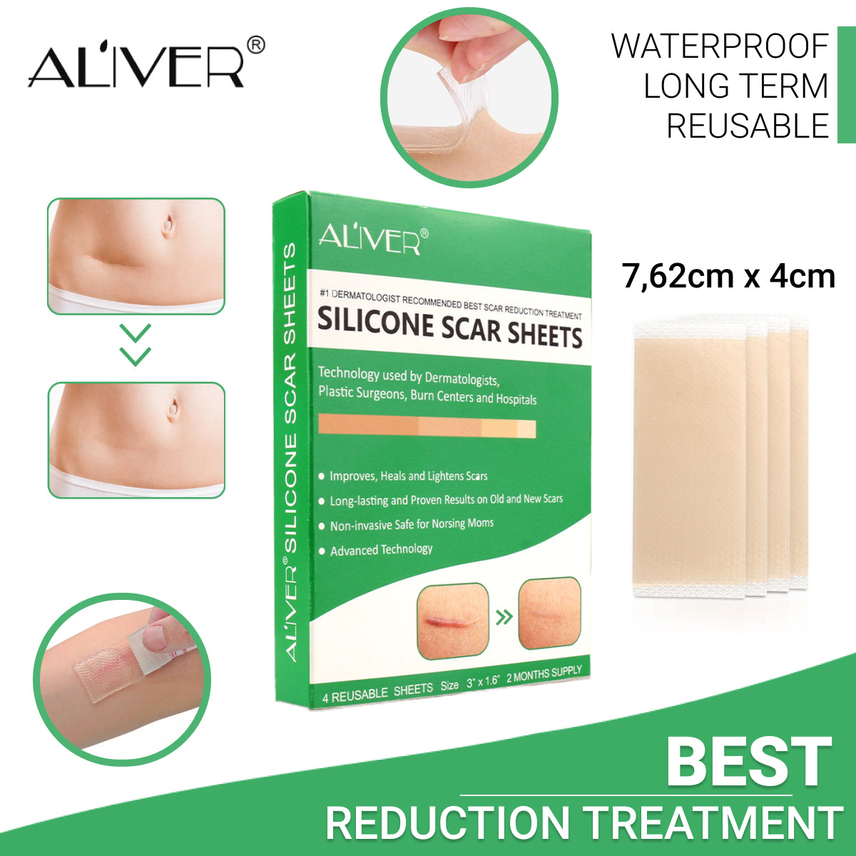 ALIVER Silicone Scar Sheets, Reduction Treatment, pack of 4pcs