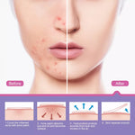 Elaimei Removal Acne Pimple Patches Plasters Face Skin Dot Stickers Cover Treatment Hydrocolloid Spot Blemishes Comedone Remover Cleaner (24 pcs )