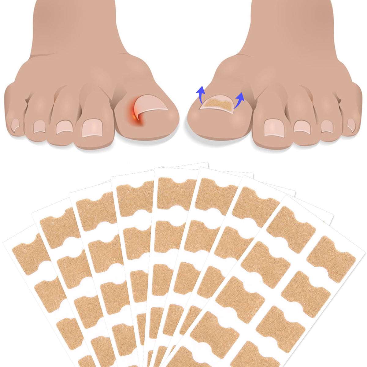 SEFUDUN Toenail Correction Stickers, pack of 100pcs