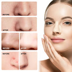 ELAIMEI Nose Pimple Patches, 12pcs