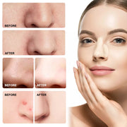 ELAIMEI Nose Pimple Patches, 12pcs