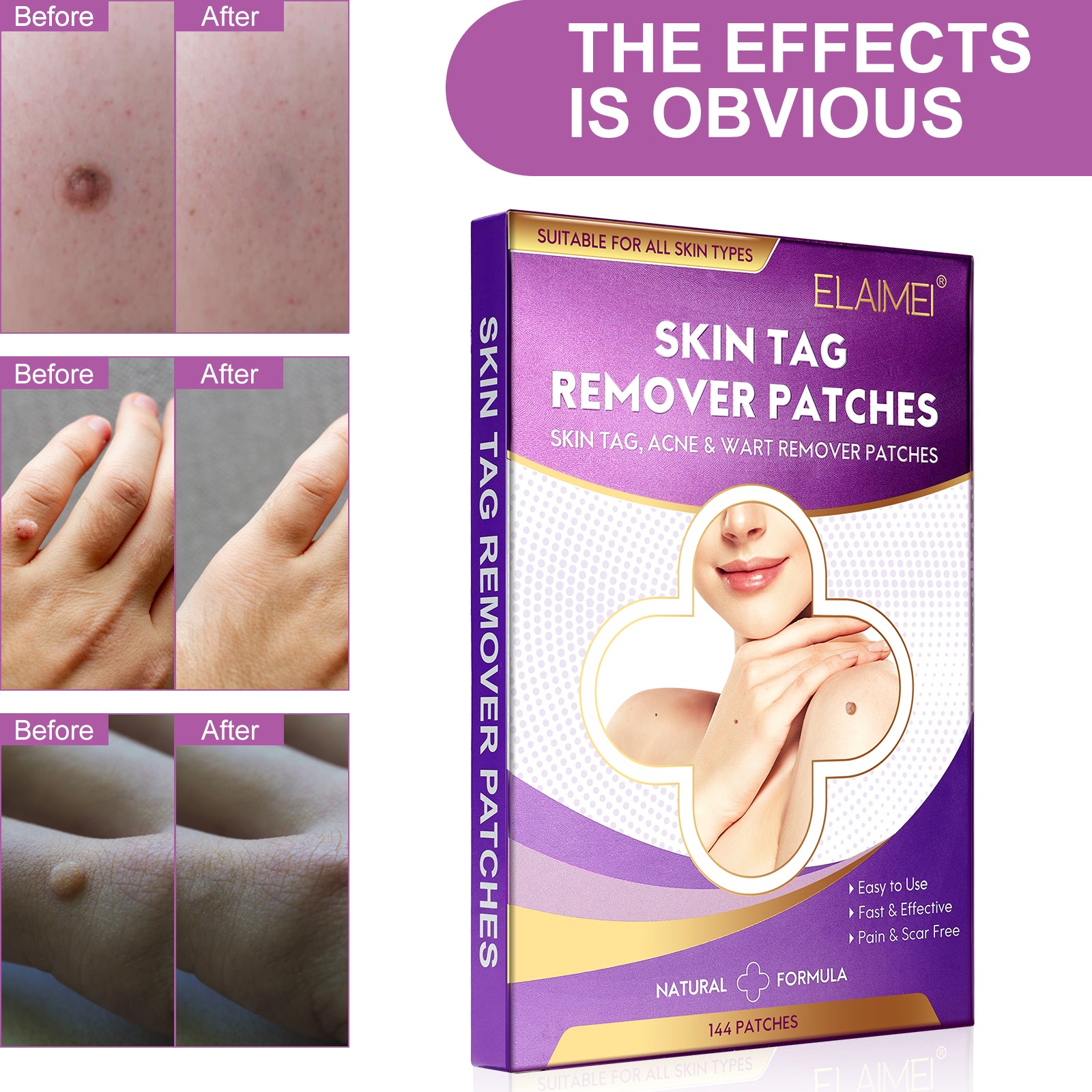 ELAIMEI Skin Tag, Acne & Wart Remover Patches, pack of 144pcs