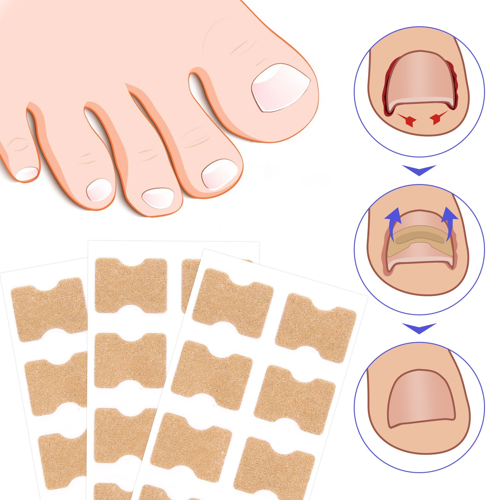 SEFUDUN Toenail Correction Stickers, pack of 100pcs