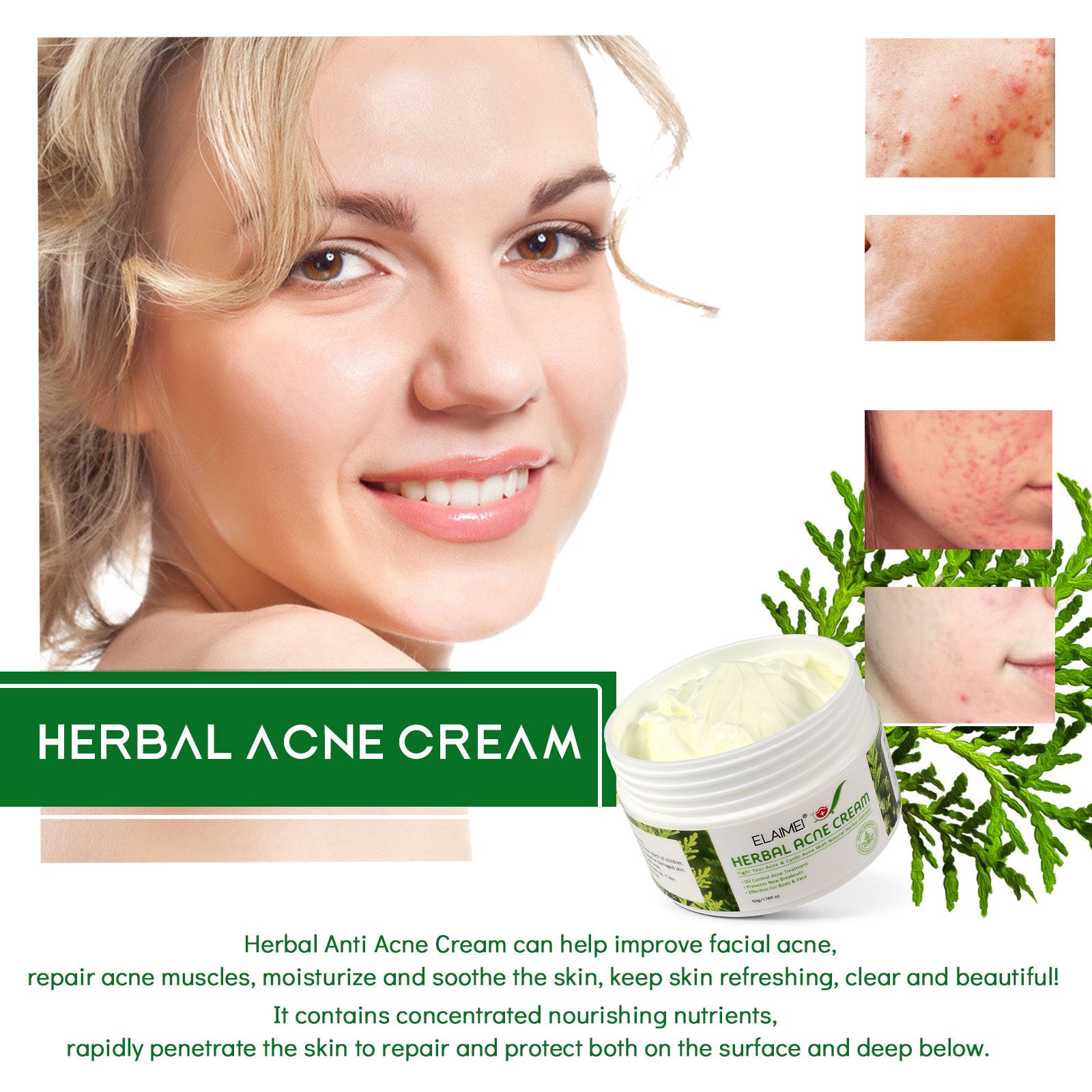 ELAIMEI Herbal Acne Treatment Cream, 50g