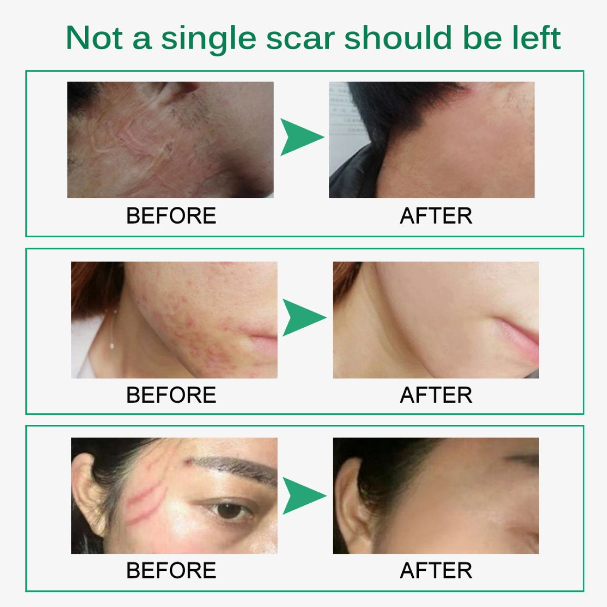 ELAIMEI Advanced Scar Removal Cream, 50ml