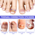 SEFUDUN Toenail Correction Stickers, pack of 100pcs