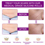 Elaimei Silicone Scar Removal Gel Tape Roll for Skin Treatment Repair 1.5 m