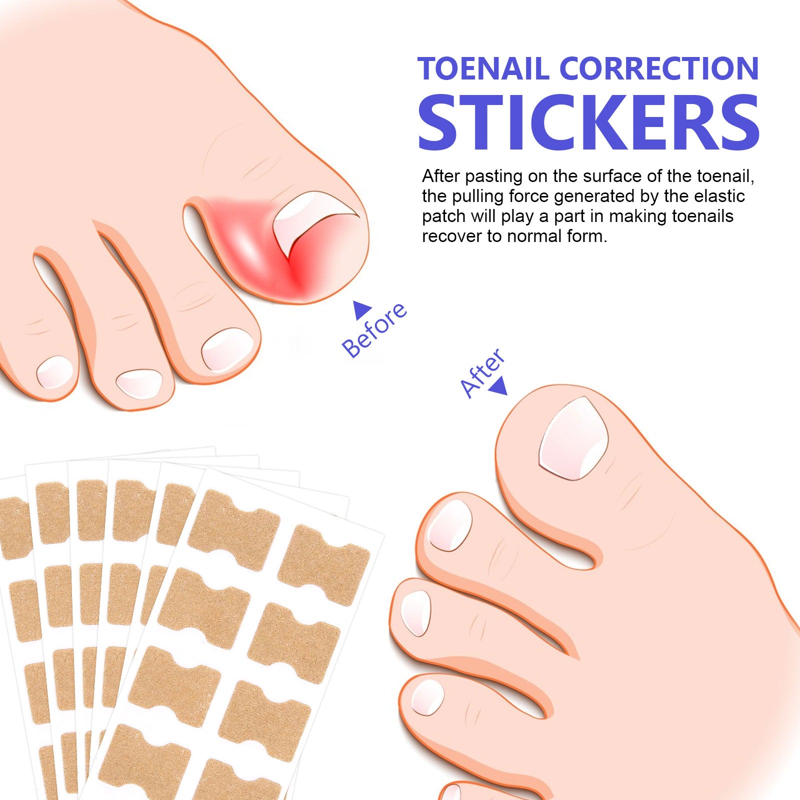 SEFUDUN Toenail Correction Stickers, pack of 100pcs