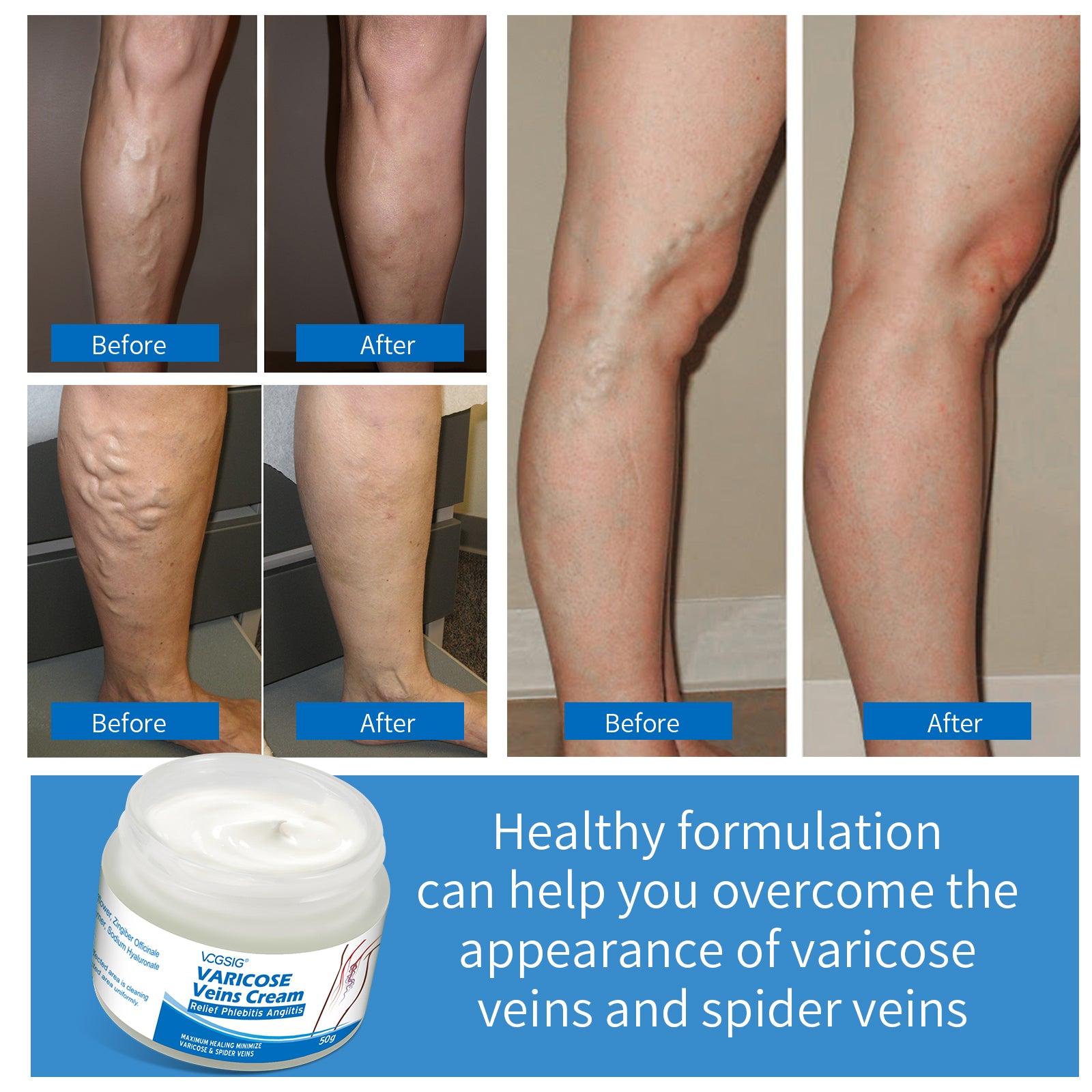 VOGSIG Varicose Veins Cream, 50g
