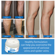 VOGSIG Varicose Veins Cream, 50g
