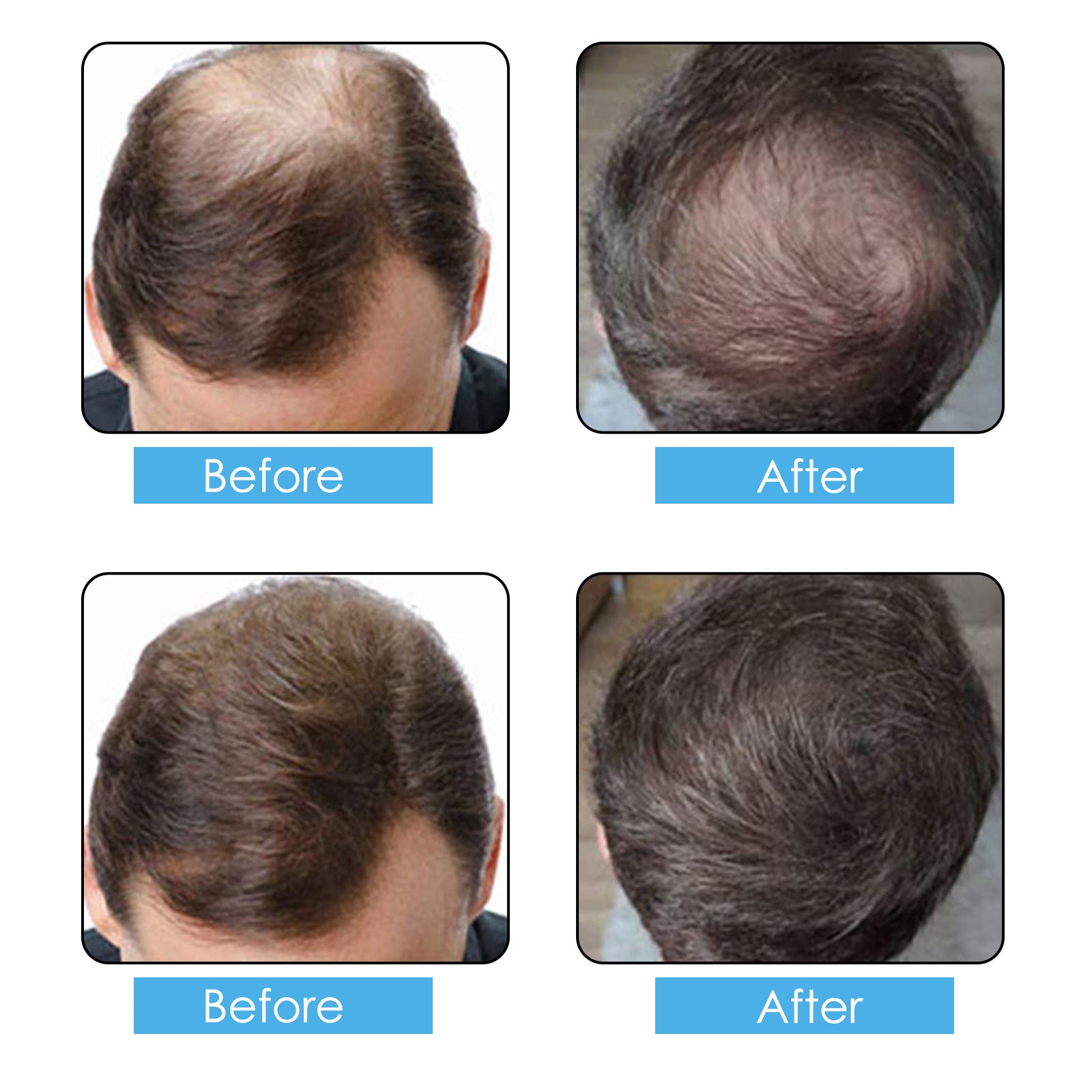 ELAIMEI Hair Loss Building Fibers, 100g (MEDIUM BROWN)