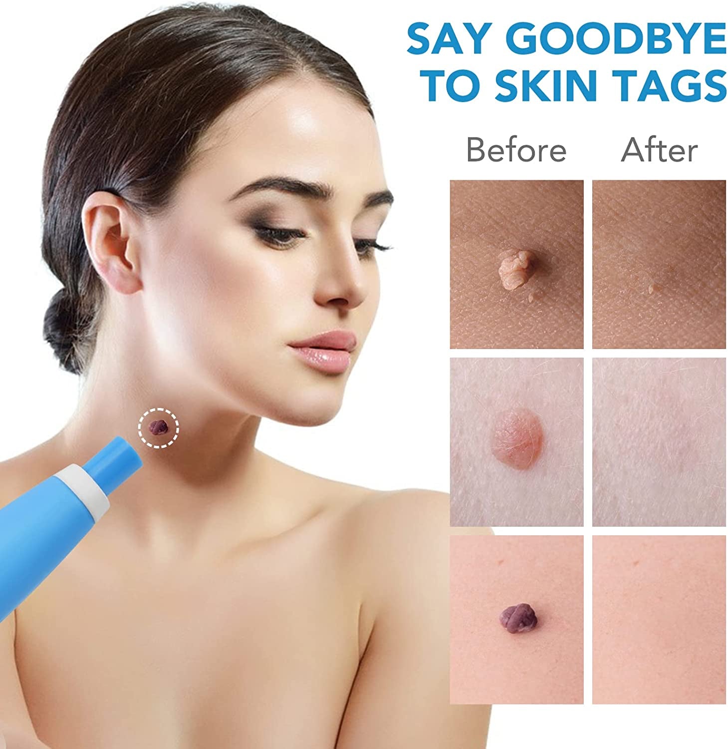 ALIVER 2in1 Gentle Skin Tag Removal Kit