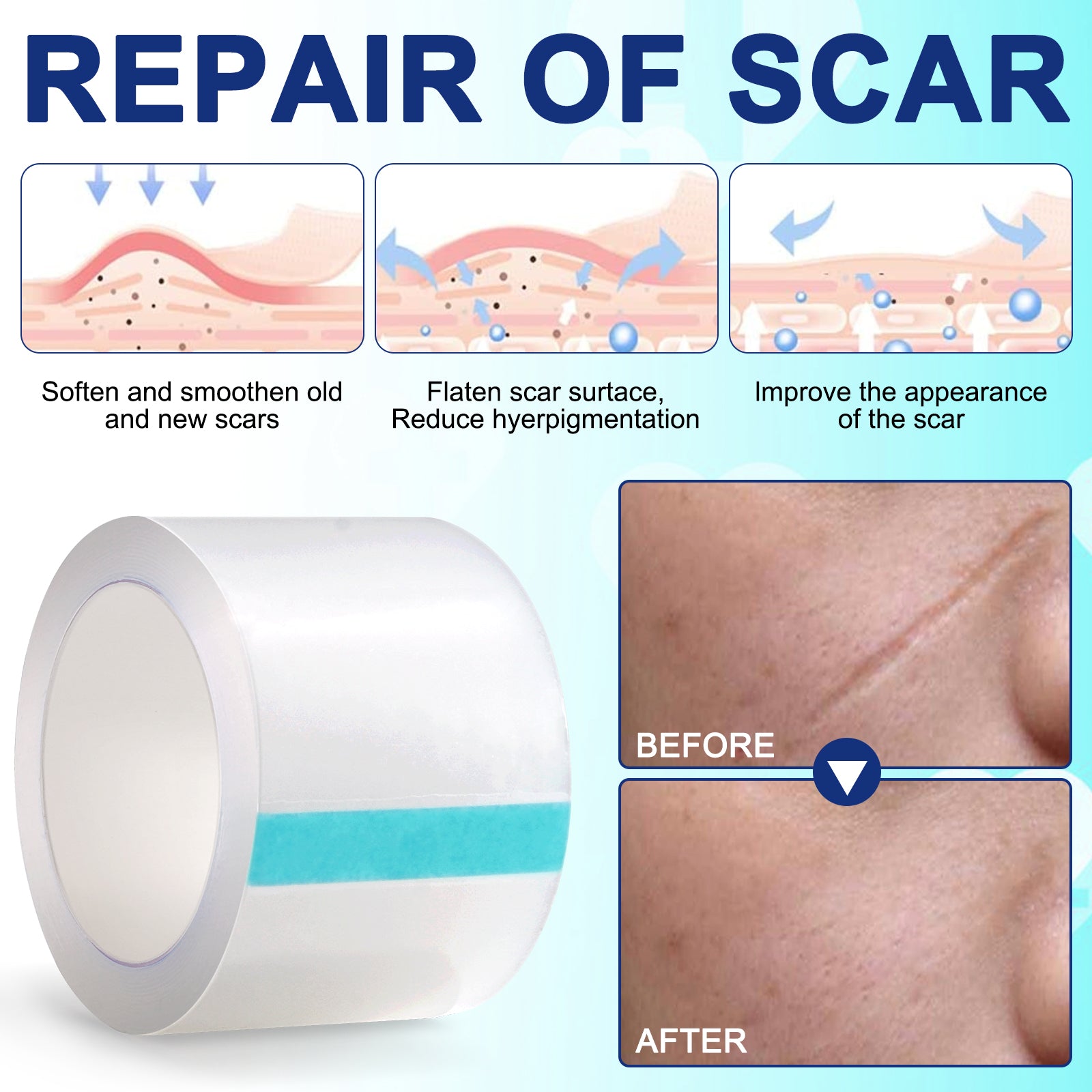 ALIVER Silicone Scar Removal Sheet, 1.5m
