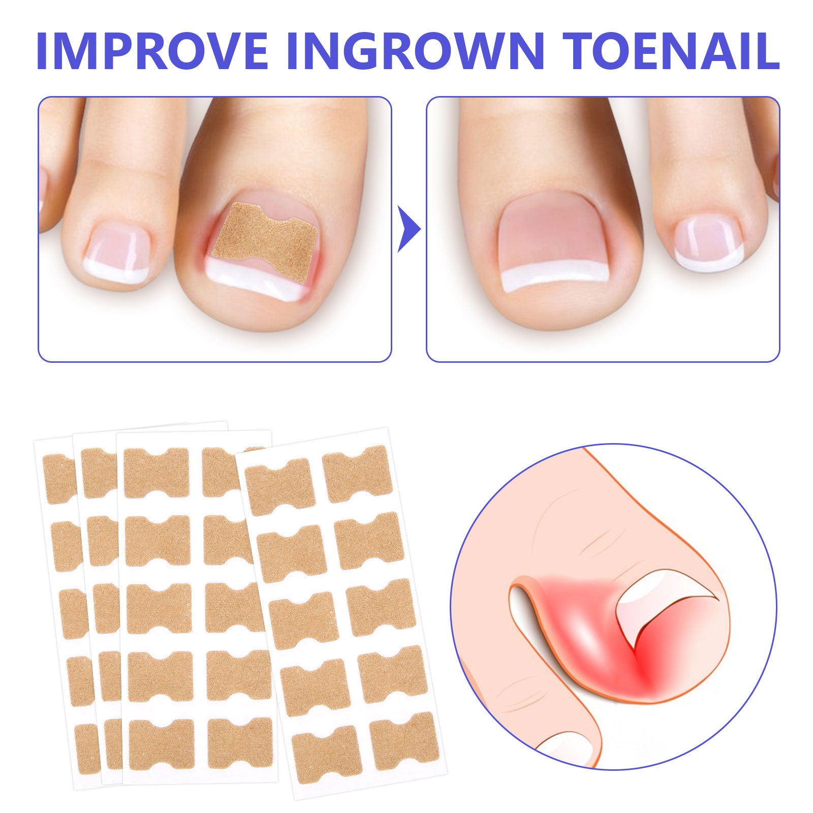 SEFUDUN Toenail Correction Stickers, pack of 100pcs