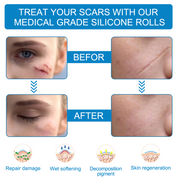 VALLEYLUX Silicone Scar Tape, 1.5m