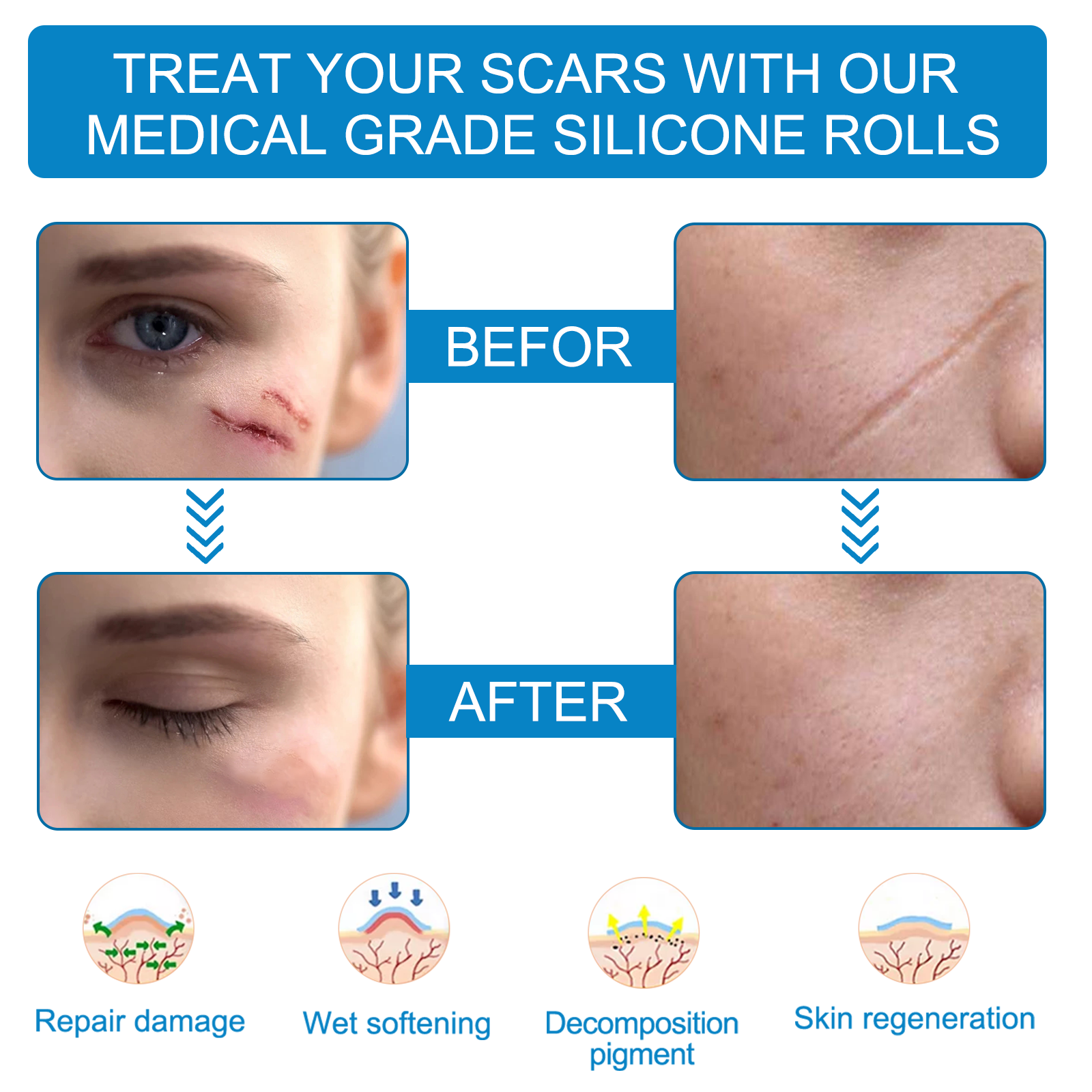 VALLEYLUX Silicone Scar Tape, 1.5m