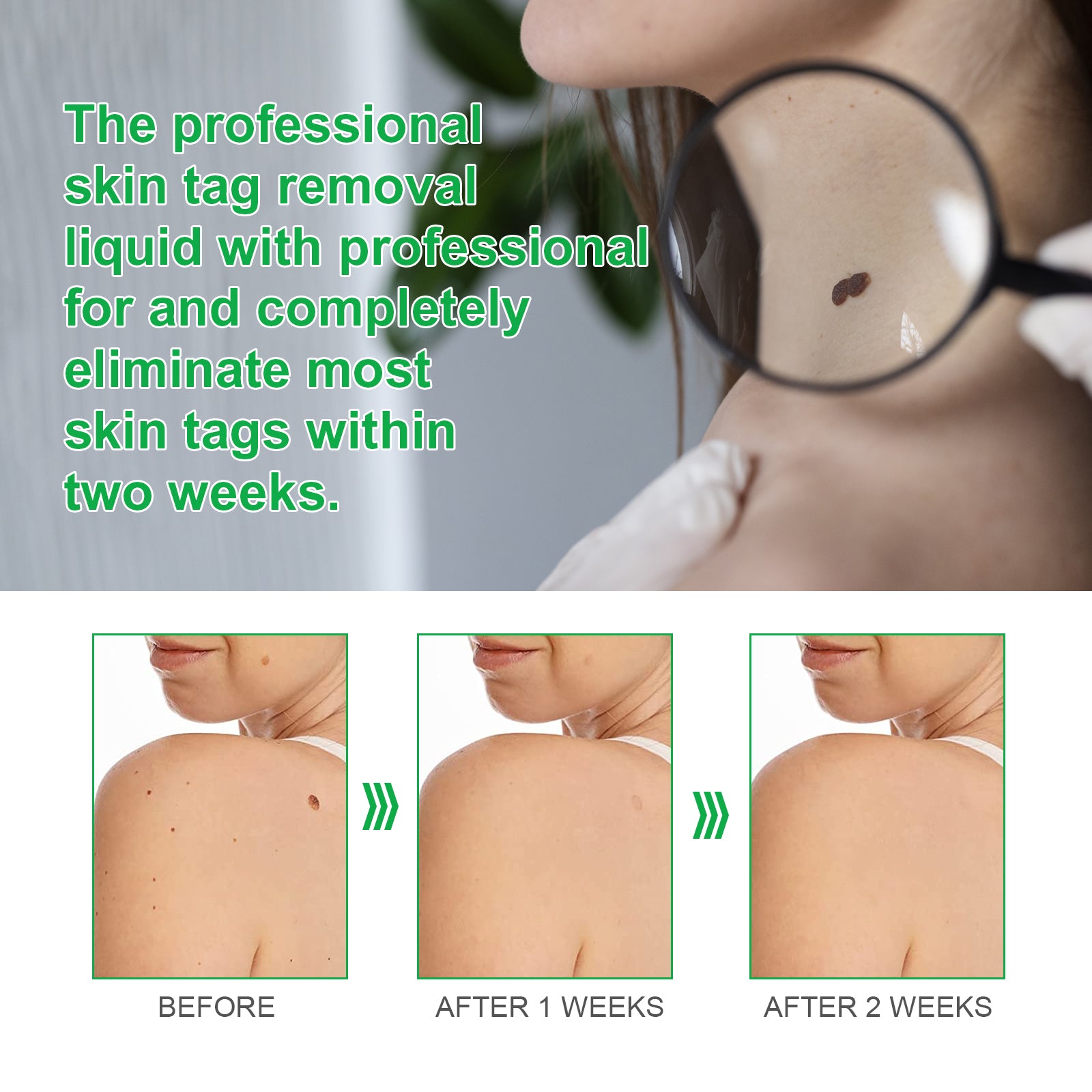 ALIVER Body Skin Tag & Wart Remover Ointment, 20g