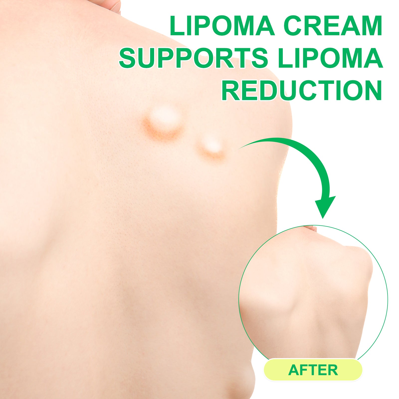 SEFUDUN Lipoma Removal Cream, 20g