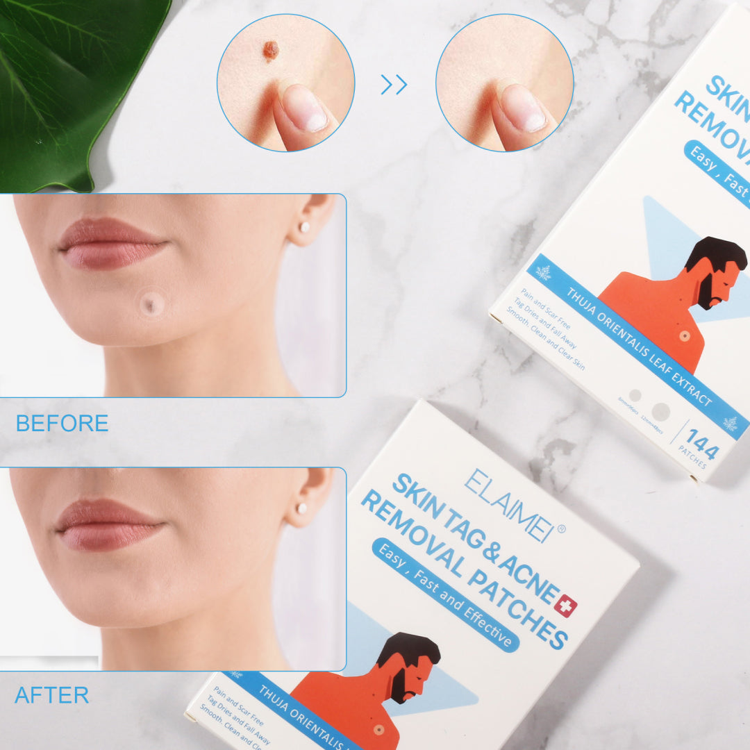 ELAIMEI Patches for Skin Tag & Acne Removal, 144pcs