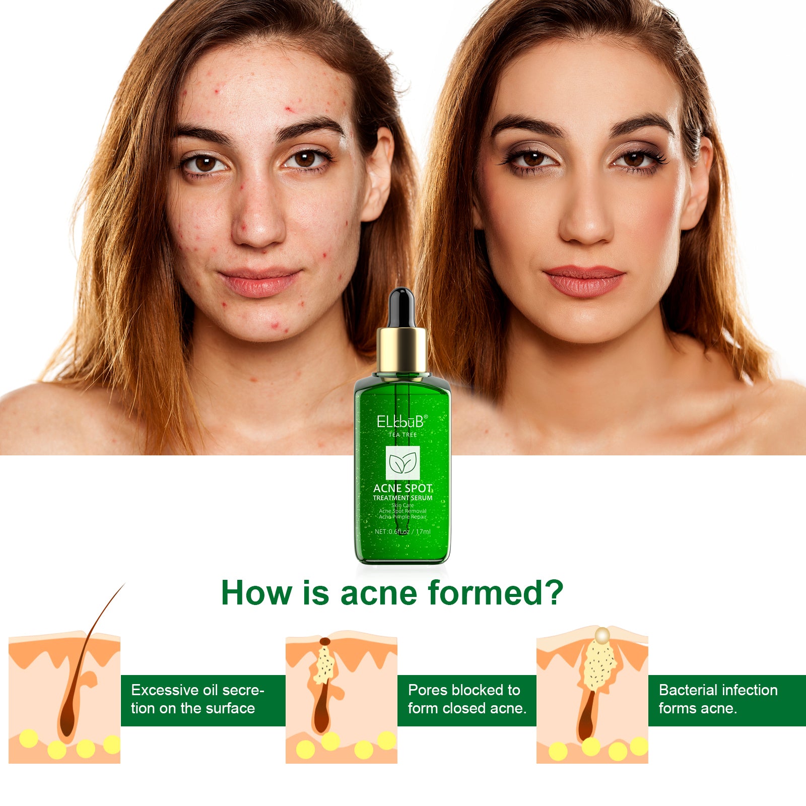 ELBBUB Acne Spot Treatment Serum, Tea Tree, 17ml