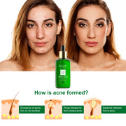 ELBBUB Acne Spot Treatment Serum, Tea Tree, 17ml