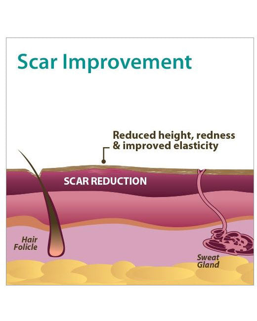 ALIVER Silicone Scar Sheets, Reduction Treatment, pack of 4pcs