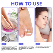 SEFUDUN Toenail Correction Stickers, pack of 100pcs