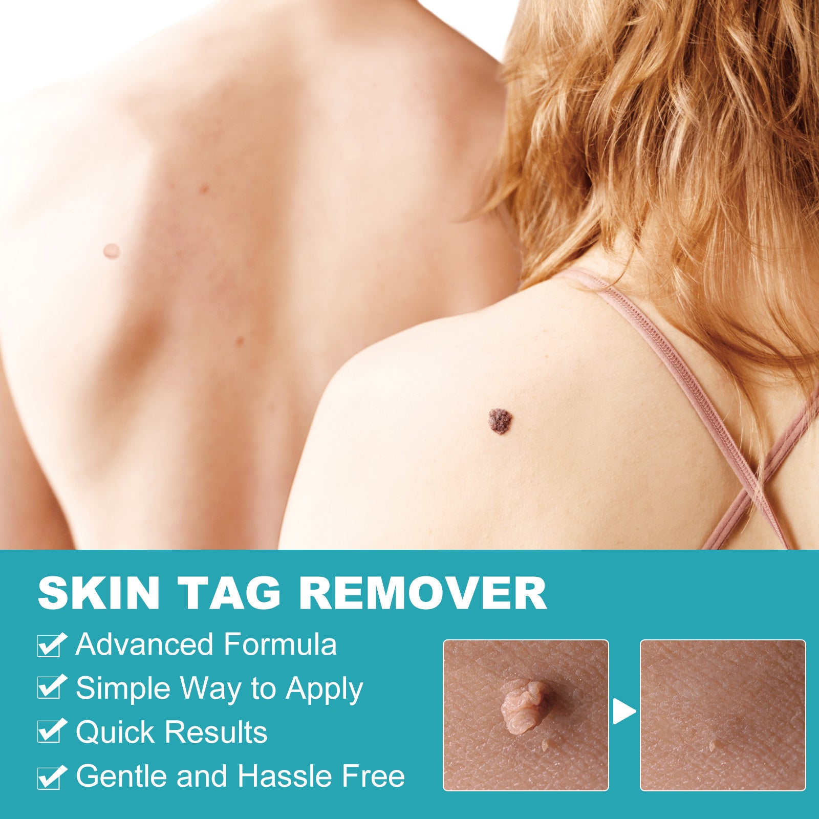 ELAIMEI 2in1 Fast & Effective Skin Tag Remover Kit