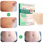 Elaimei Silicone Sheets for Scar Removal