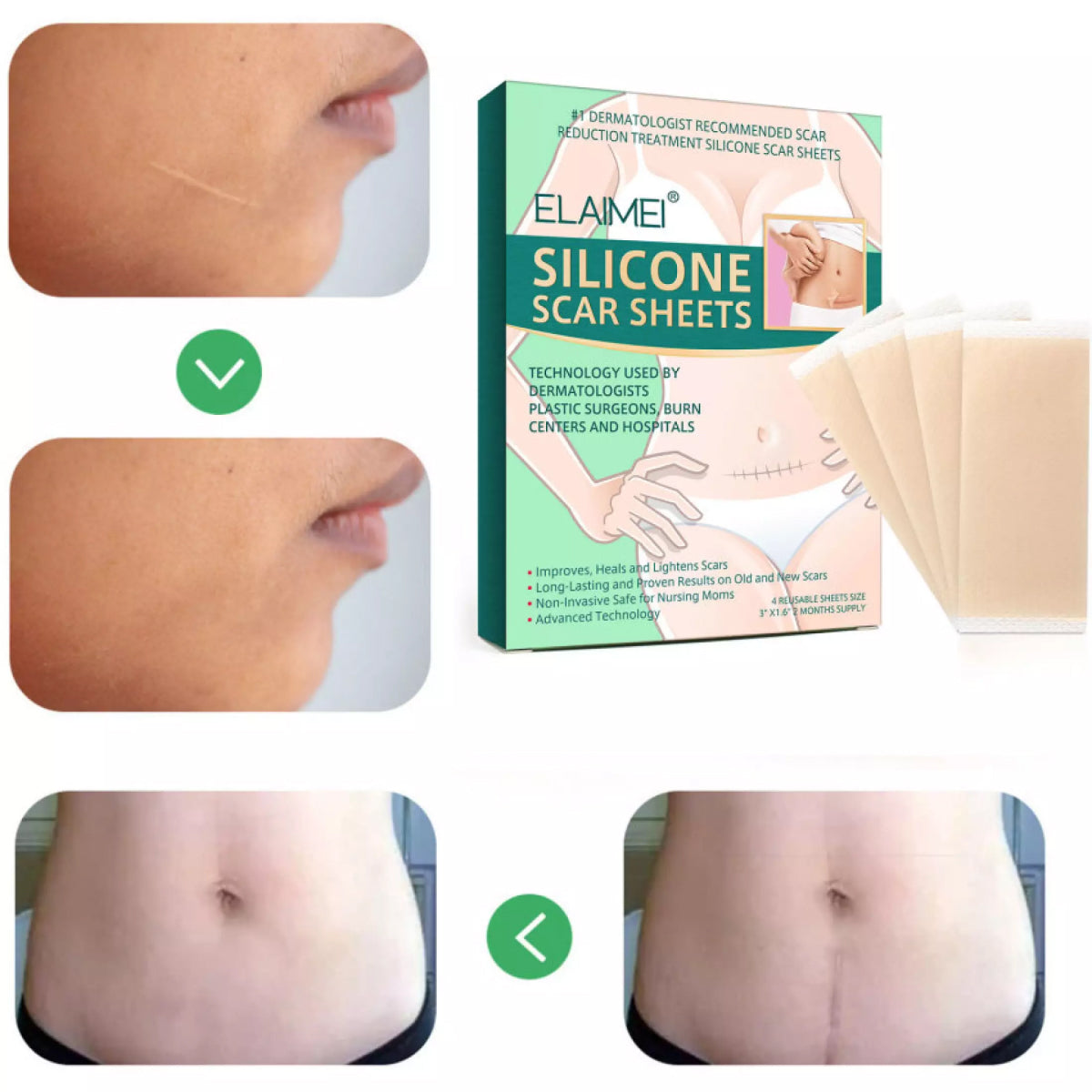 Elaimei Silicone Sheets for Scar Removal