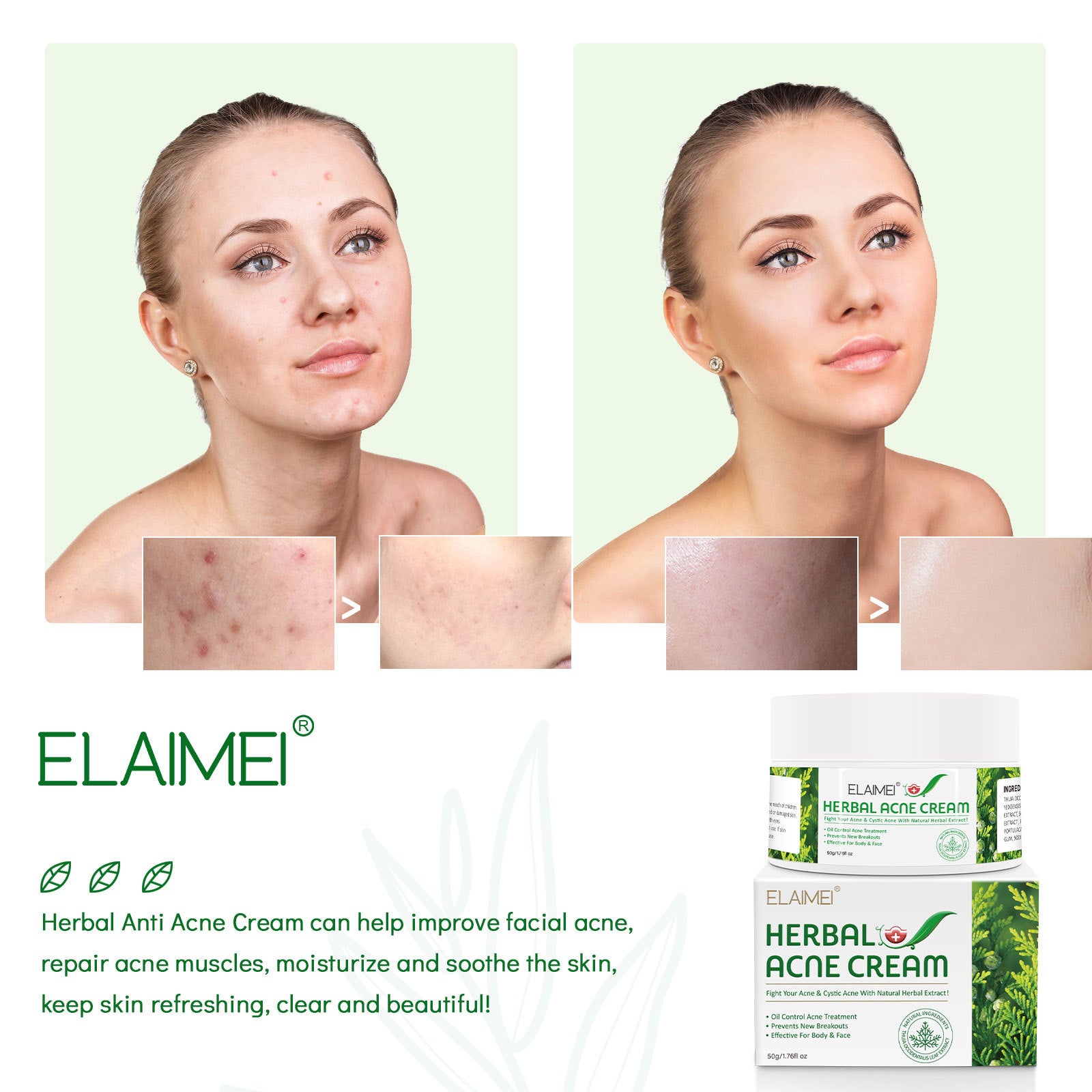 ELAIMEI Herbal Acne Treatment Cream, 50g
