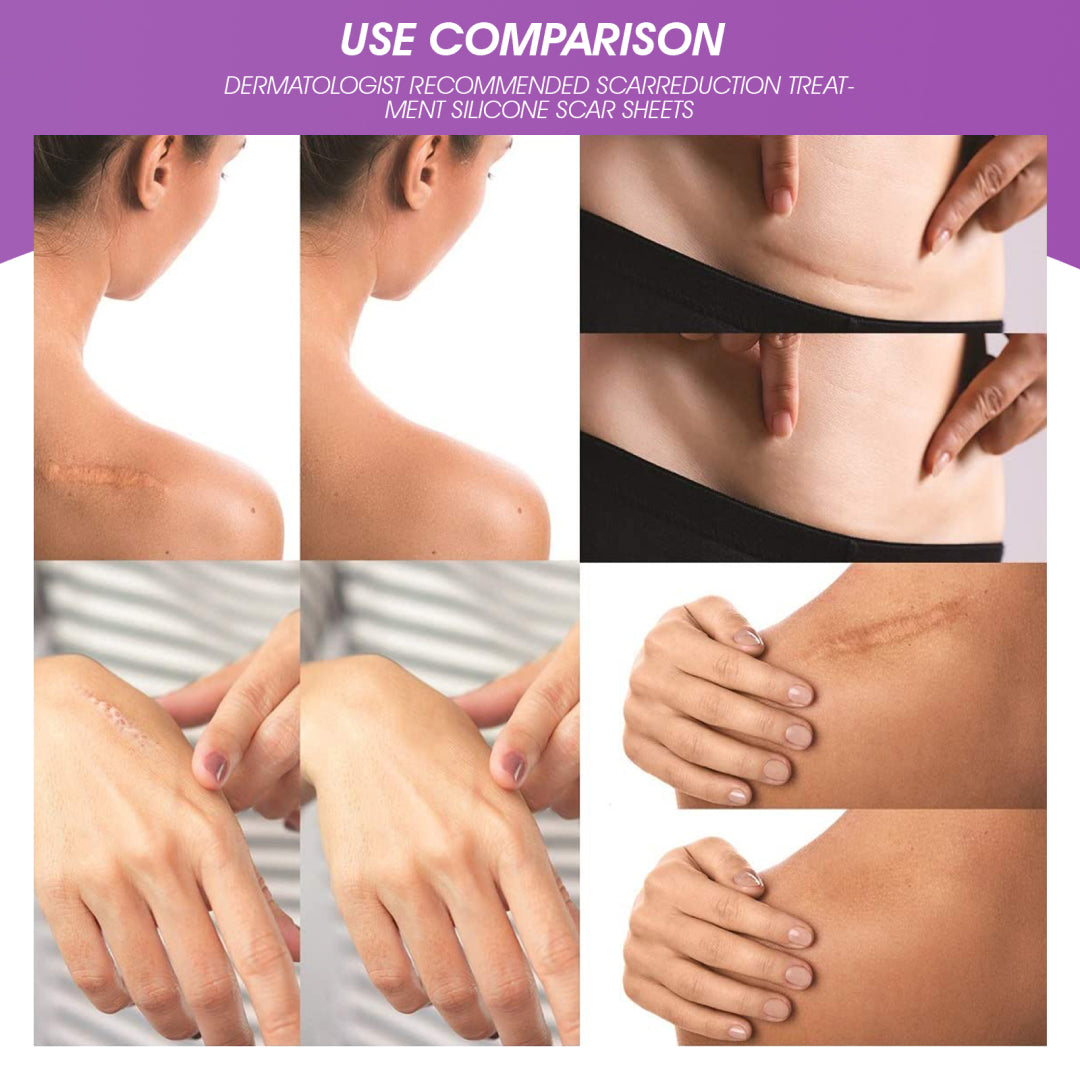 ELAIMEI Silicone Scar Gel Sheets Skin Treatment